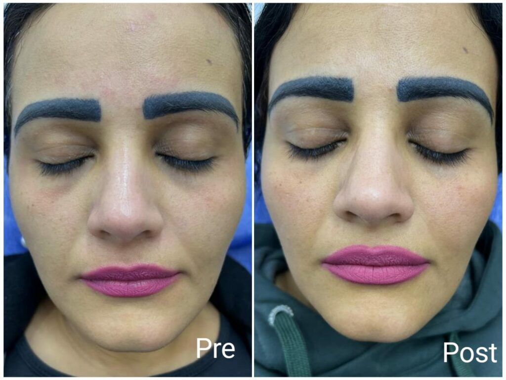 جلسات ميزو ثيرابي للتفتيح وشد الوجه